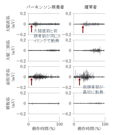 パーキンソン病写真